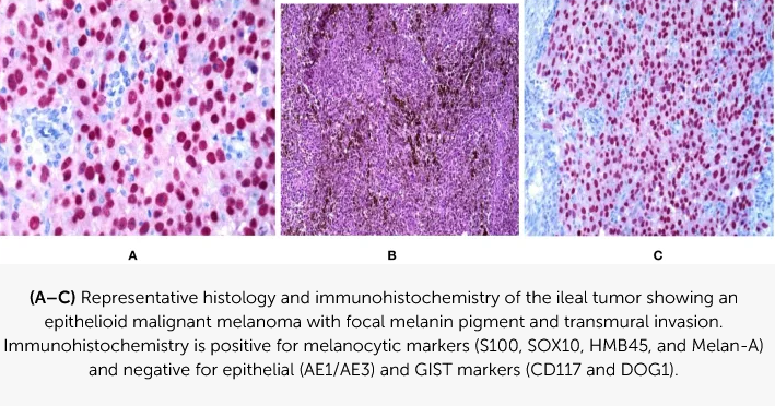 Representative histology and immunohistochemistry of the ileal tumor - TG24.info