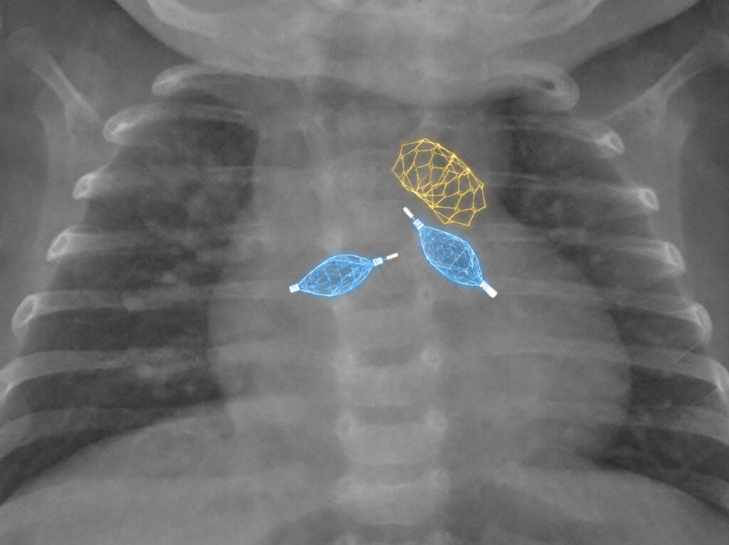 Radiografia intervento stent giallo e plug blu - TG24.info